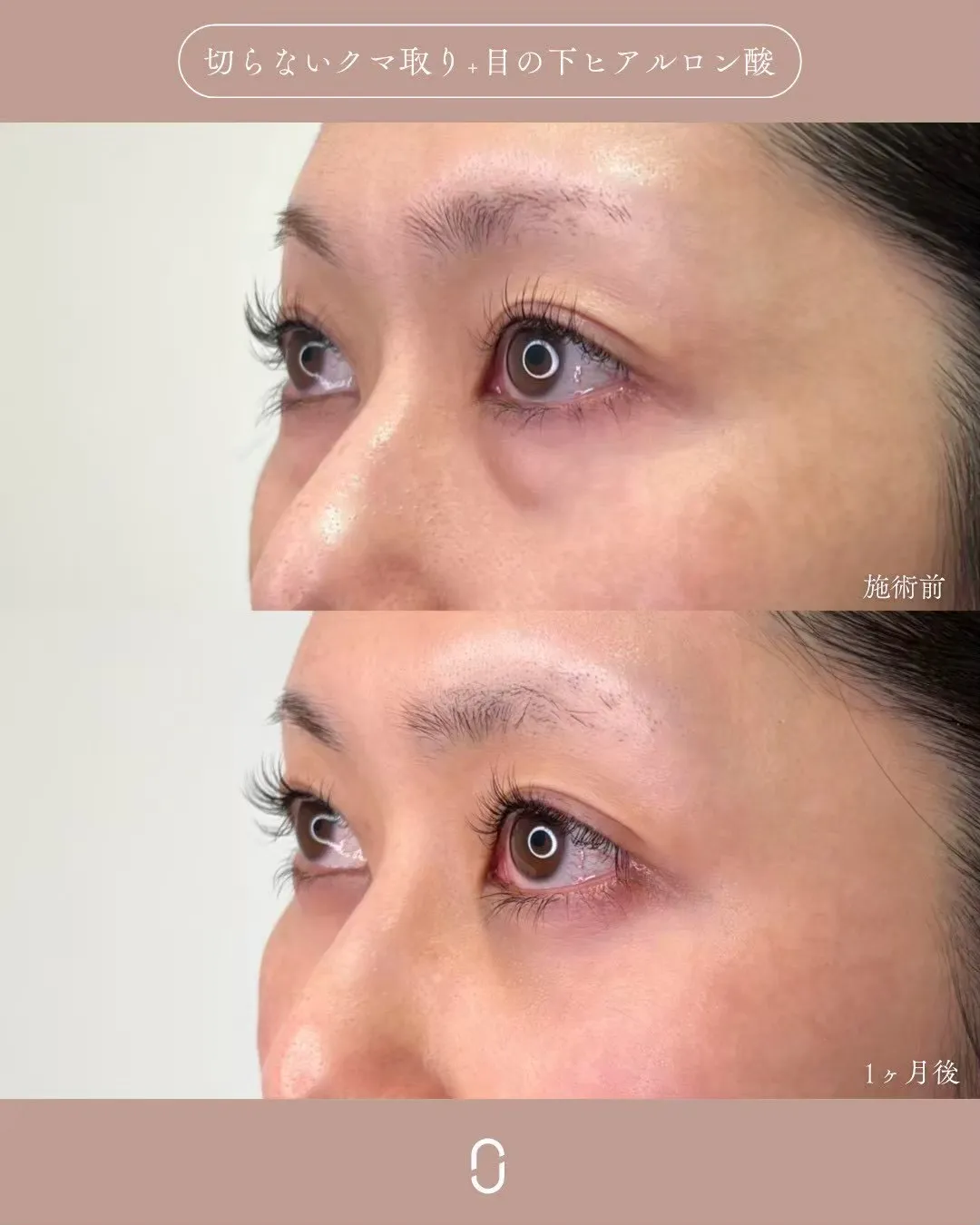 クマ取りセット1_左横 Before/After
