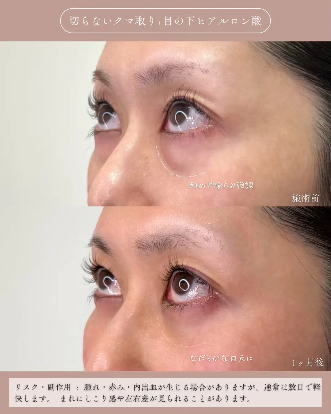 クマ取りセット1_左横上向き説明あり Before/After