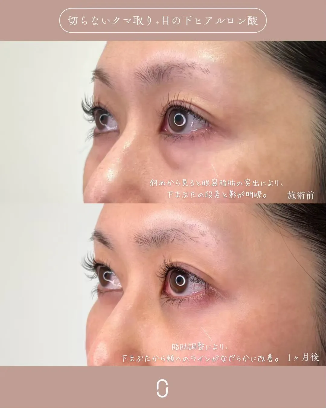 クマ取りセット1_左横説明あり Before/After