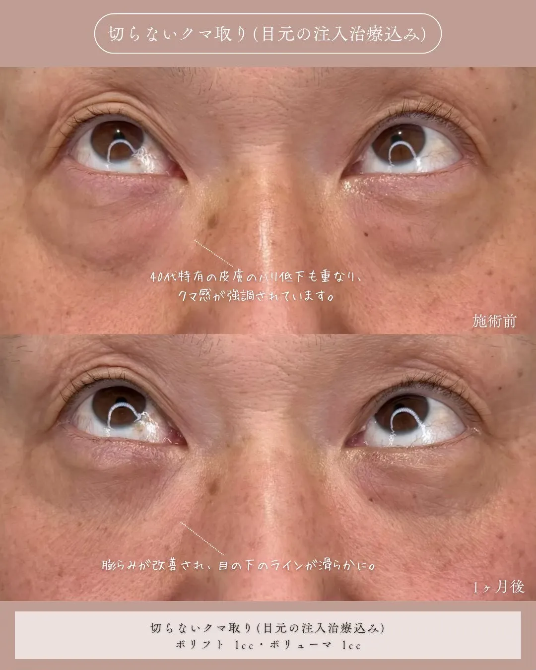 糸リフト3_正面 Before/After