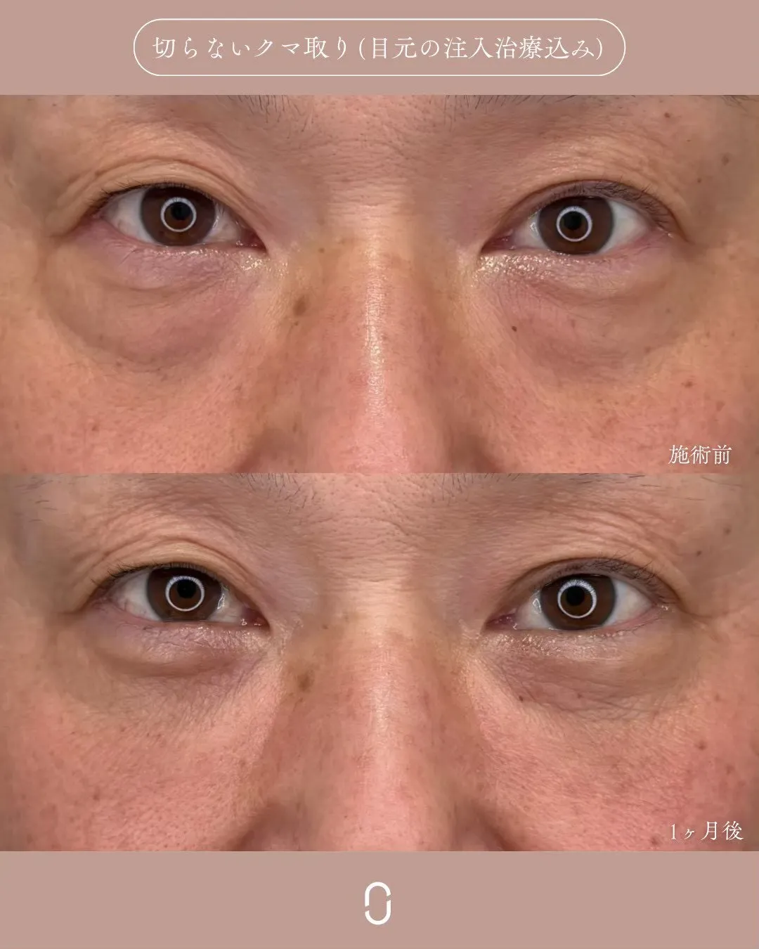 クマ取りセット2_正面ライトあり Before/After
