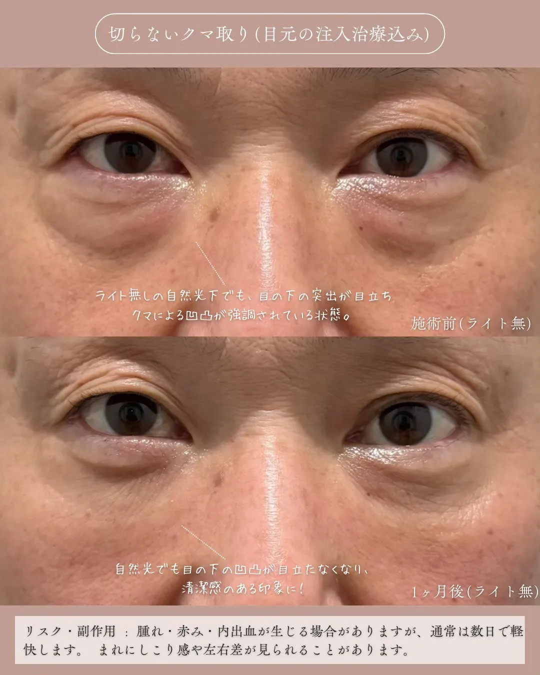 クマ取りセット2_正面ライト無し Before/After