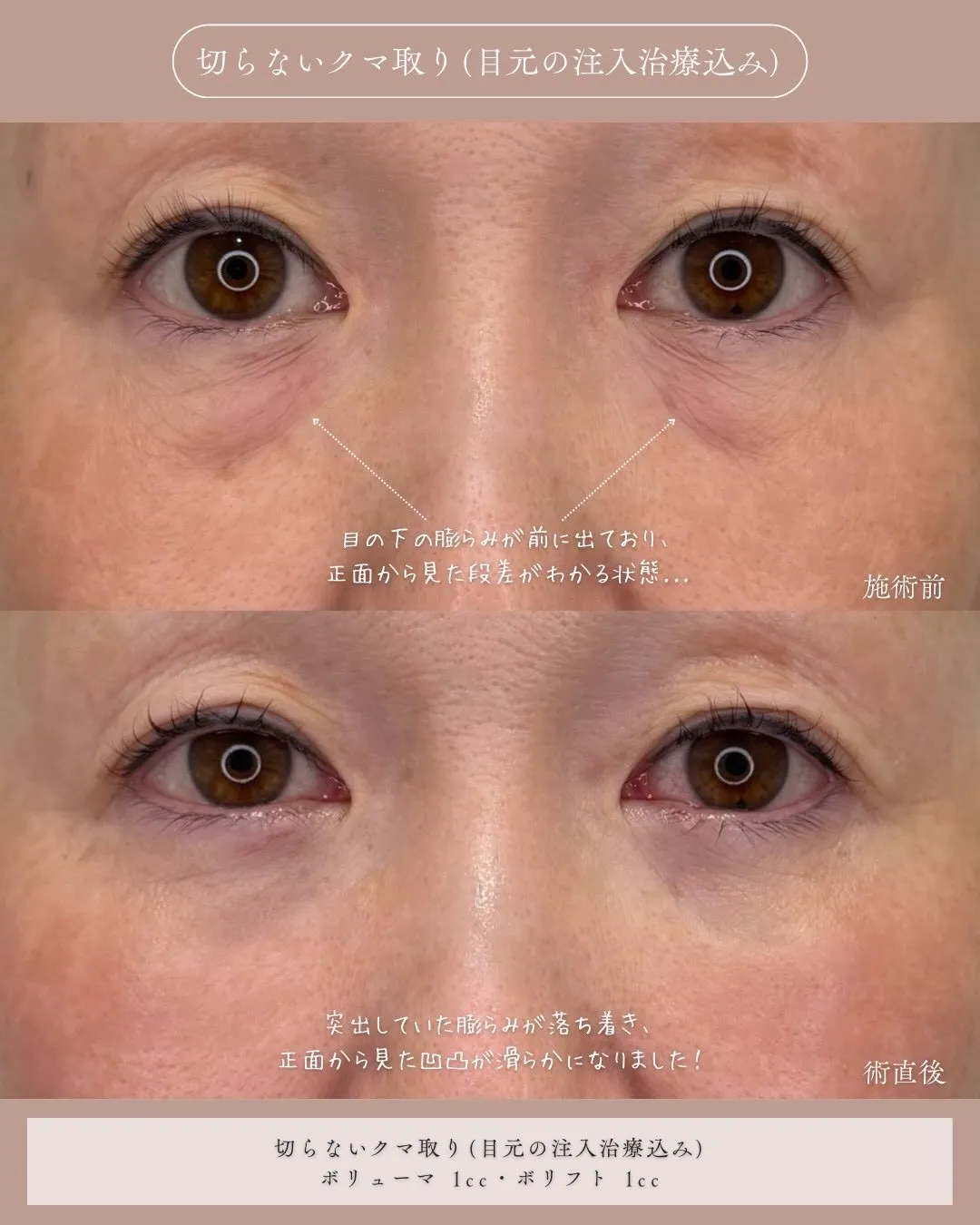クマ取りセット2_正面説明あり Before/After