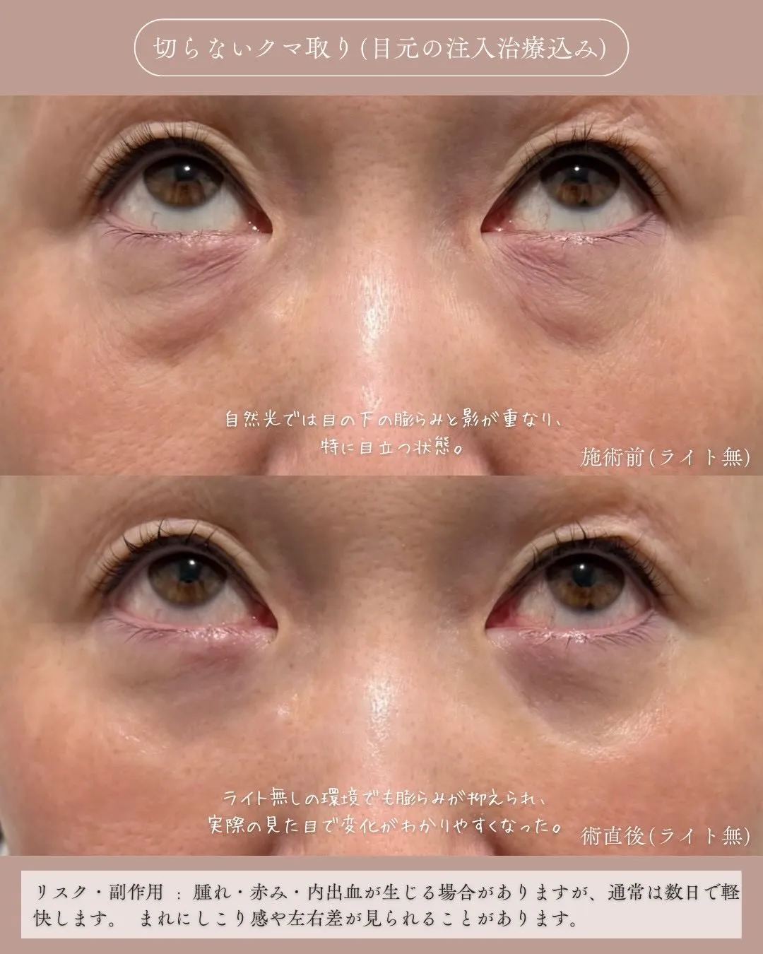 クマ取りセット3_上向きライト無し Before/After