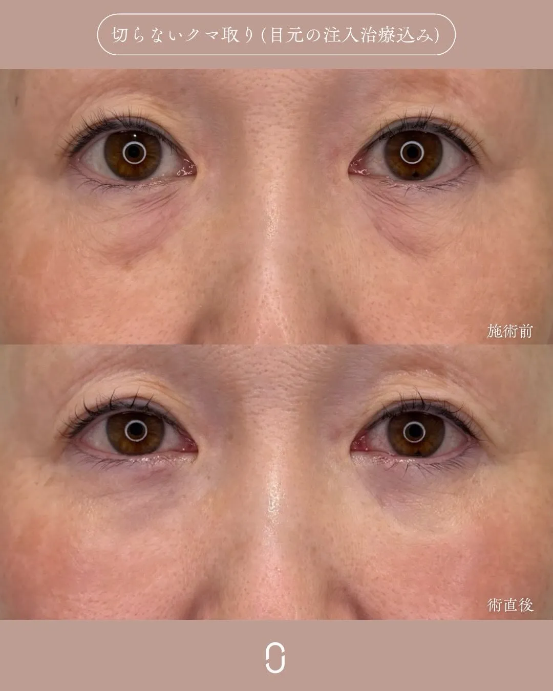 クマ取りセット3_正面 Before/After