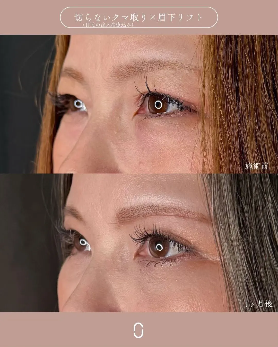 クマ取りセット＋眉下切開1_左横 Before/After