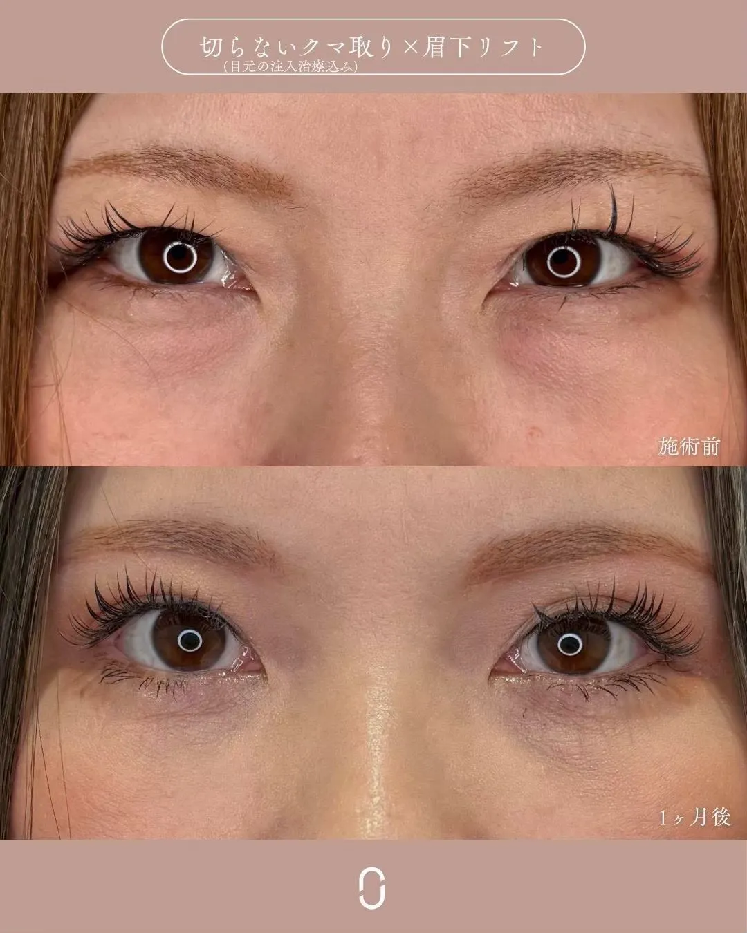 クマ取りセット＋眉下切開1_正面 Before/After