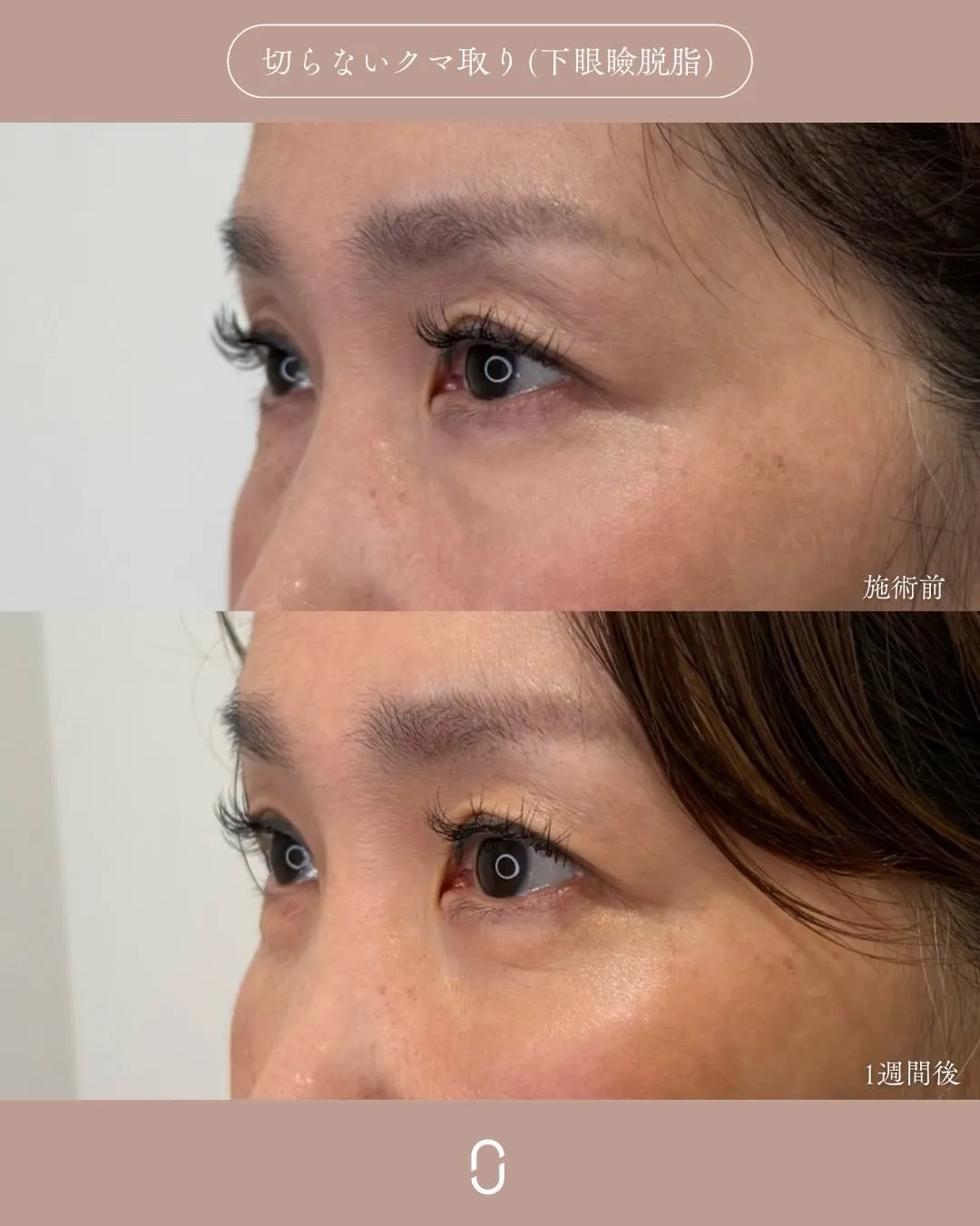 クマ取り（切らないクマ取り）2_左横 Before/After