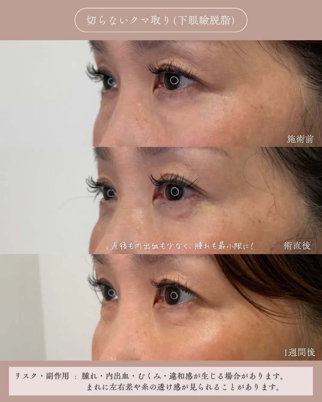 クマ取り（切らないクマ取り）2_左横経過 Before/After