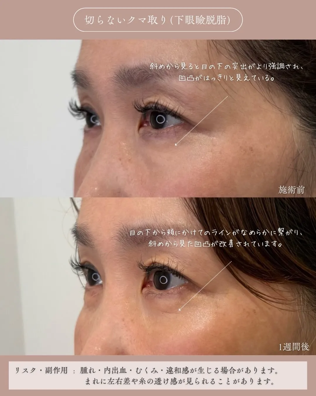 クマ取り（切らないクマ取り）2_左横説明あり Before/After