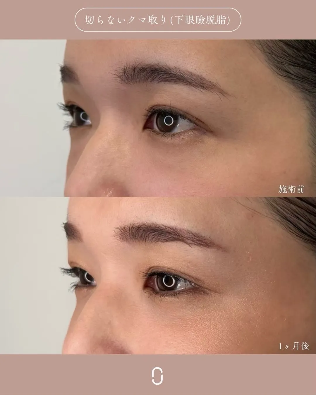 クマ取り（切らないクマ取り）3_左横 Before/After