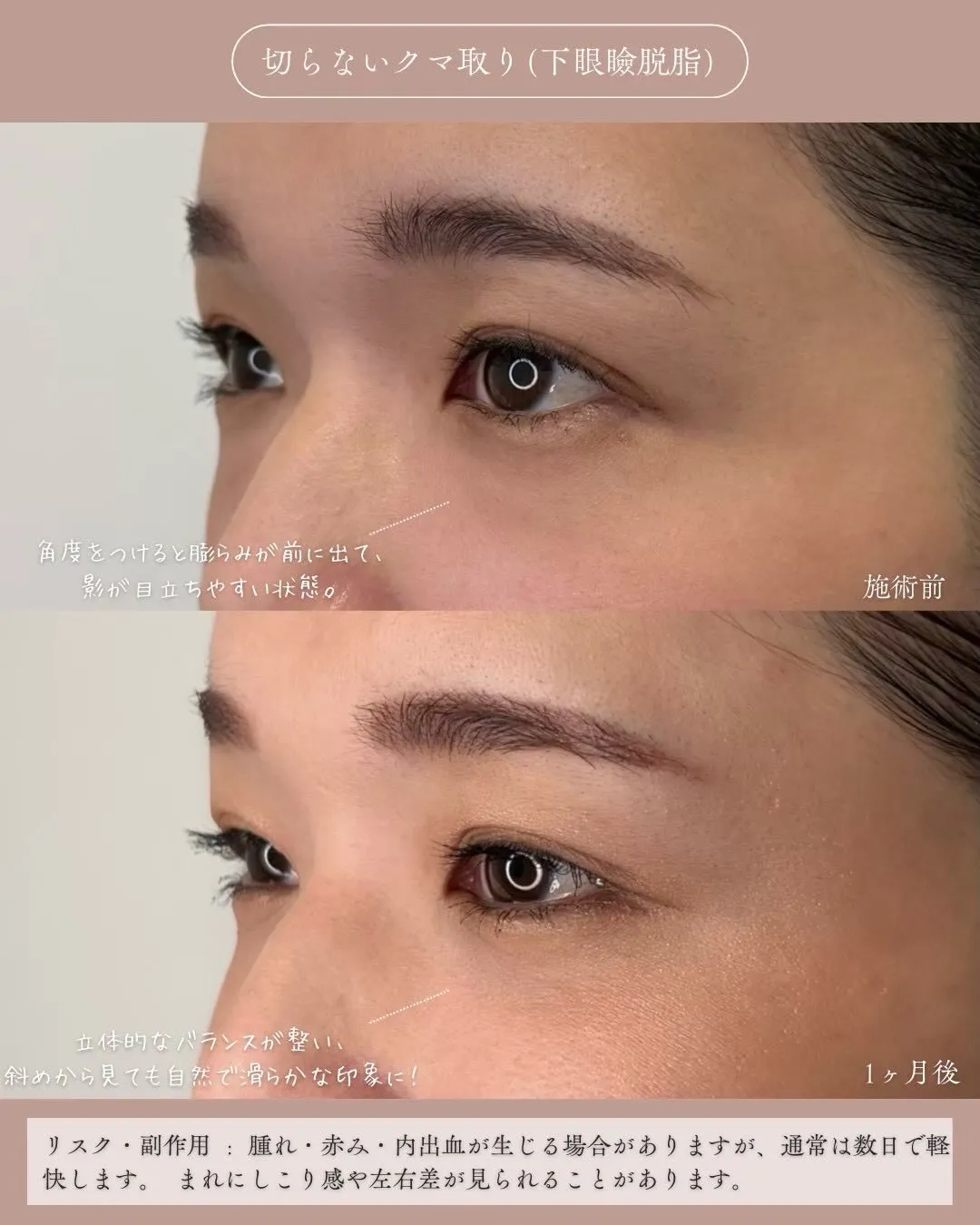 クマ取り（切らないクマ取り）3_左横説明あり Before/After