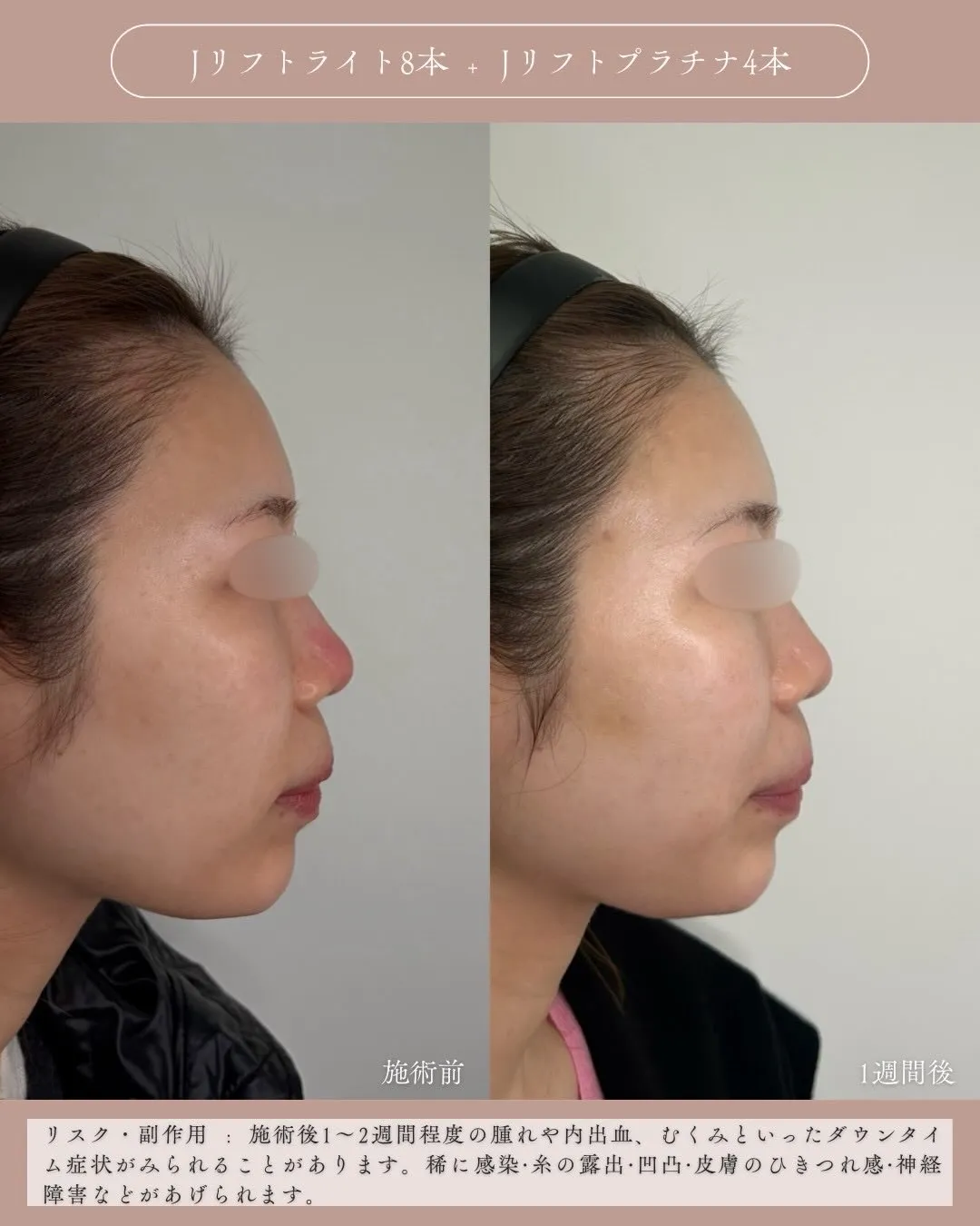 糸リフト1_横 Before/After