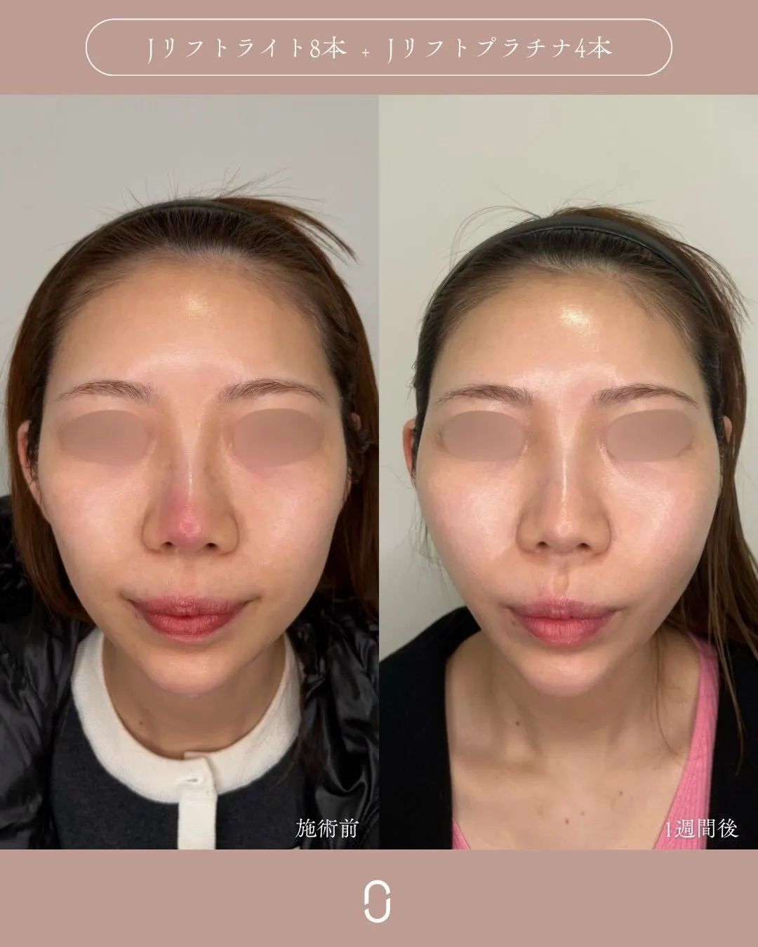 糸リフト1_正面 Before/After