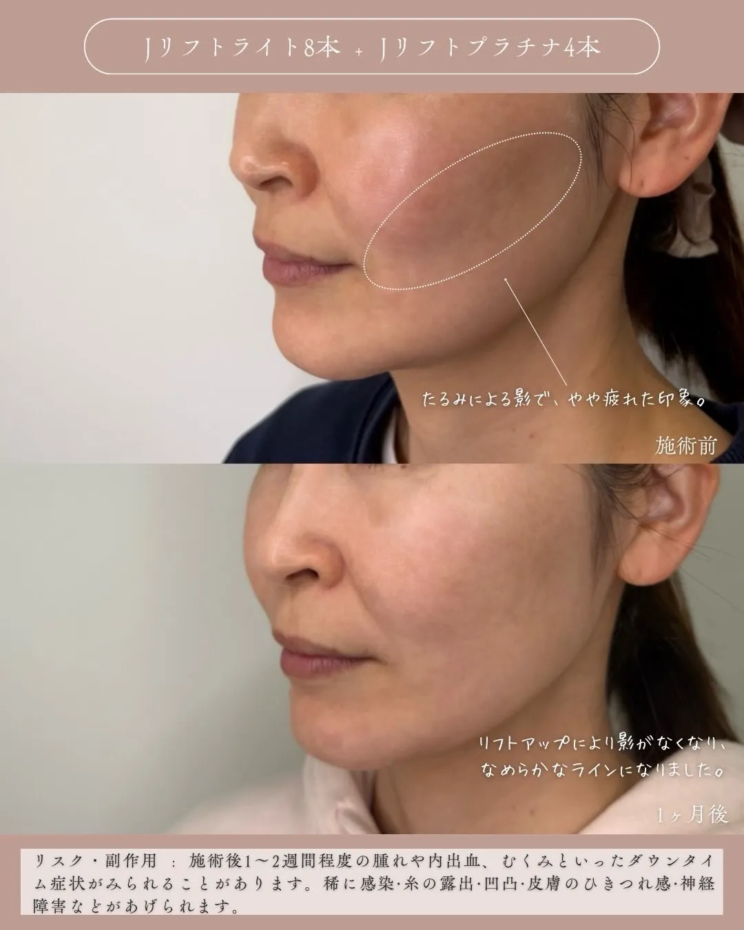 糸リフト2_左斜め Before/After