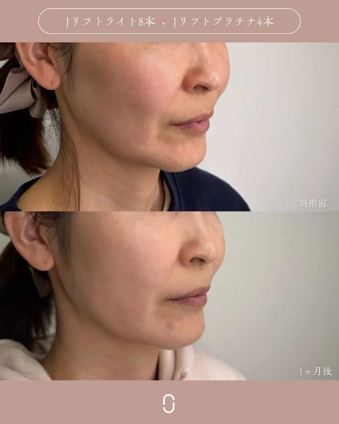 糸リフト2_右斜め Before/After