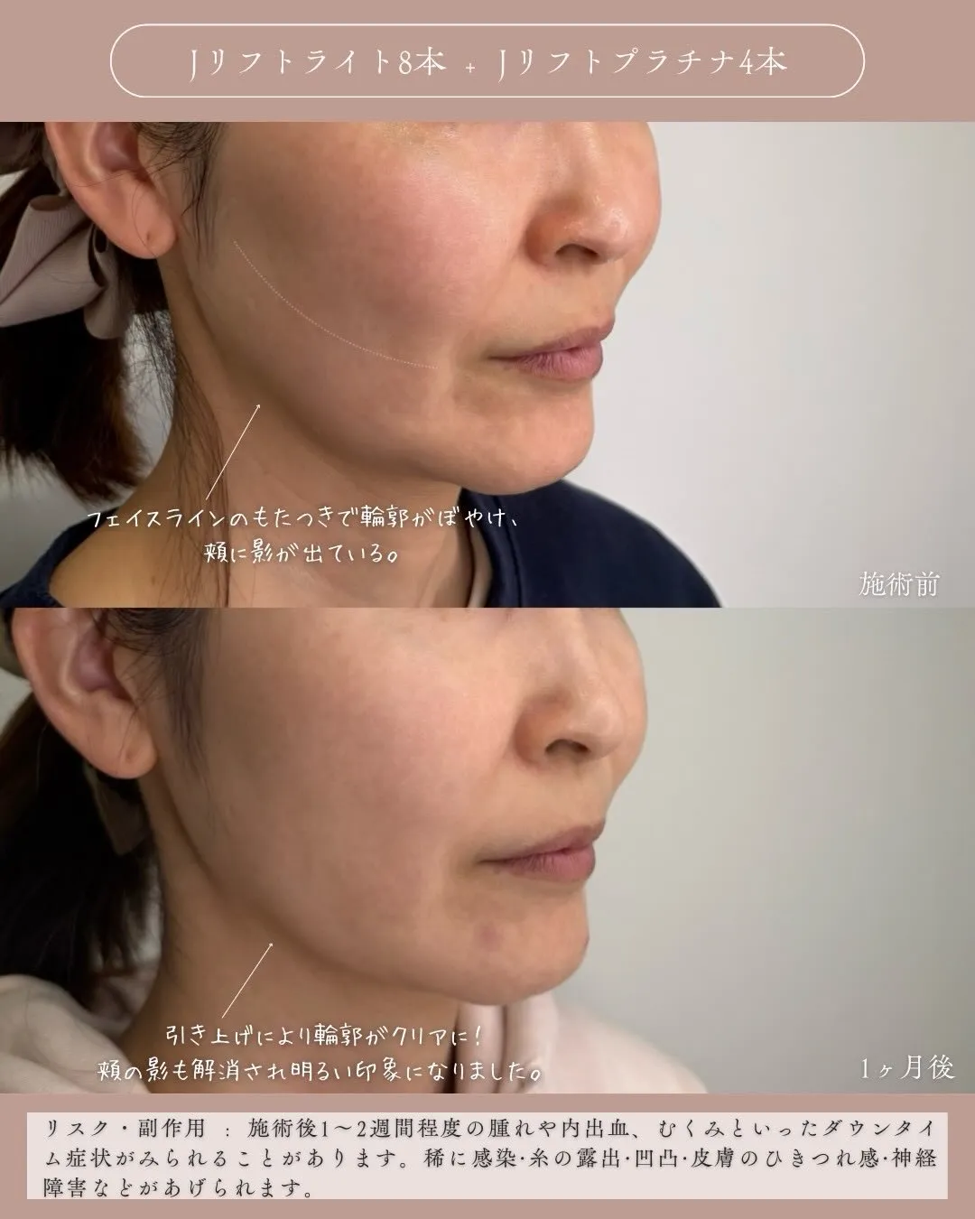 糸リフト2_右斜め説明あり Before/After
