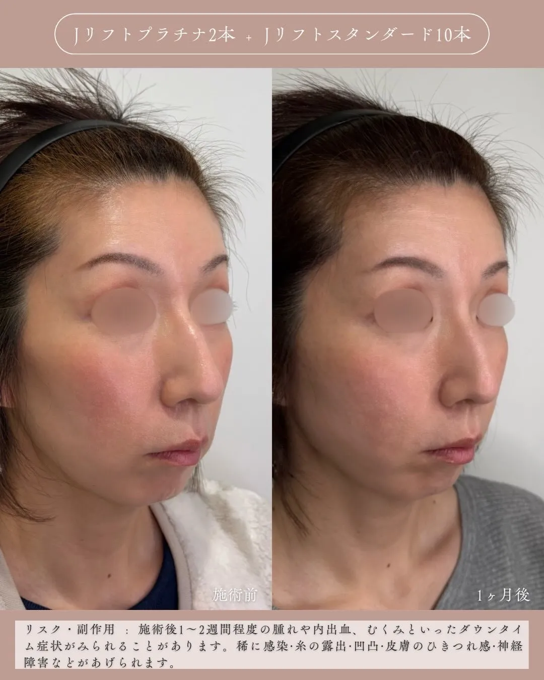 糸リフト3_右斜め説明あり Before/After
