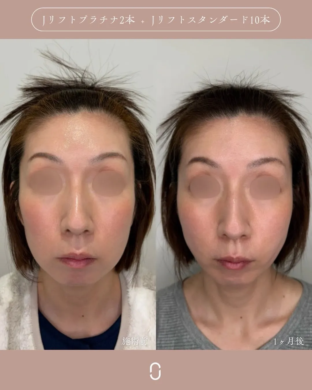 糸リフト3_正面 Before/After
