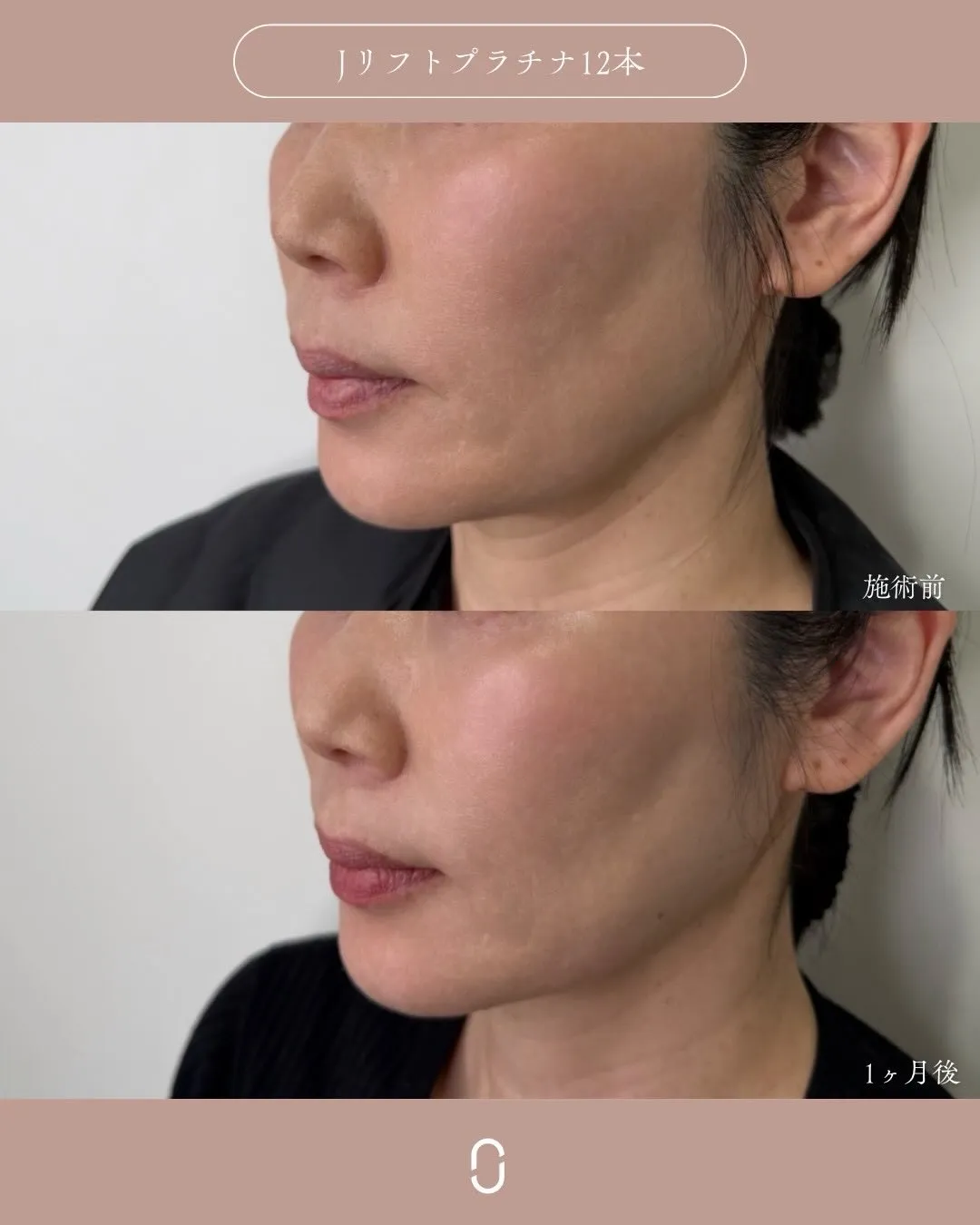 糸リフト4_左斜め Before/After
