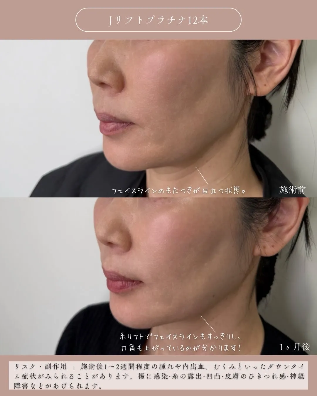 糸リフト4_左斜め説明あり Before/After
