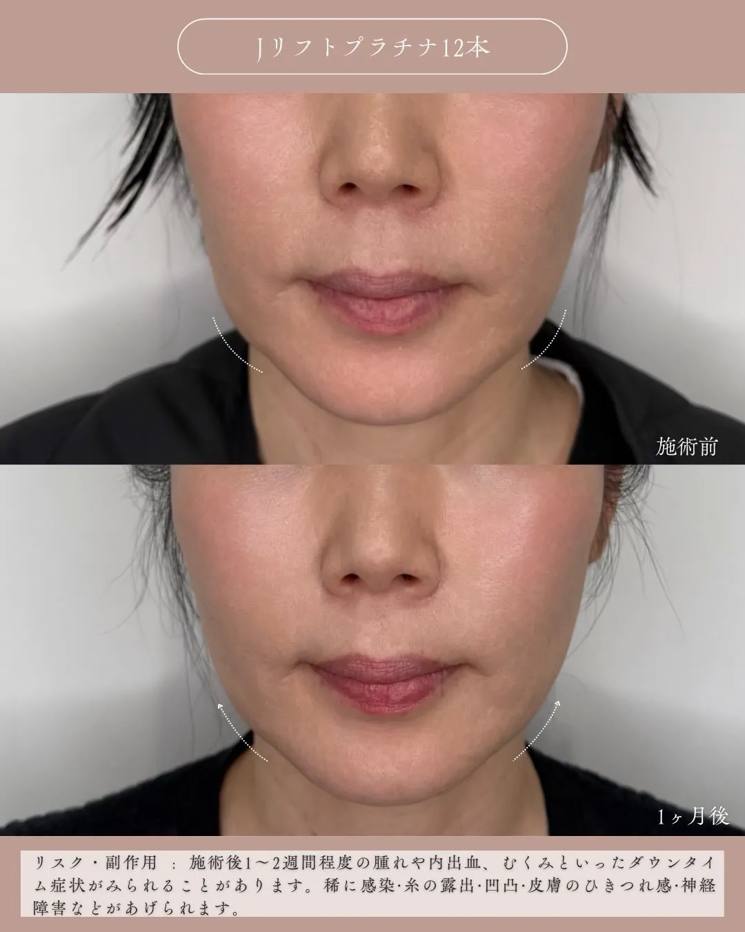 糸リフト4_正面説明あり Before/After