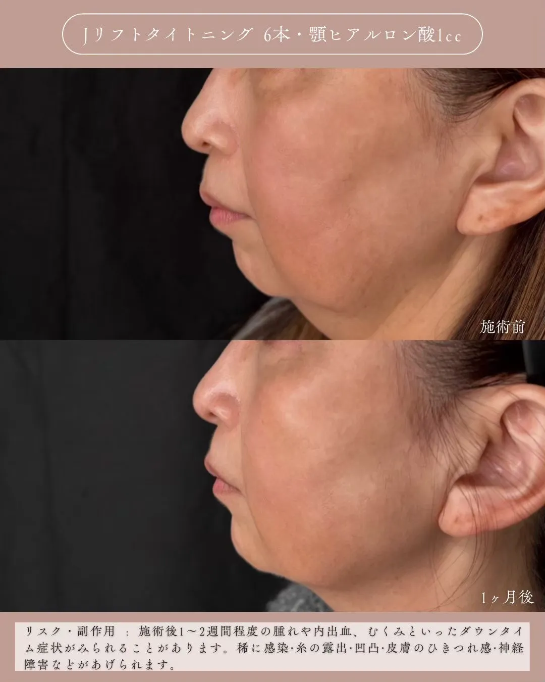 糸リフト＋ヒアルロン酸1_左横 Before/After