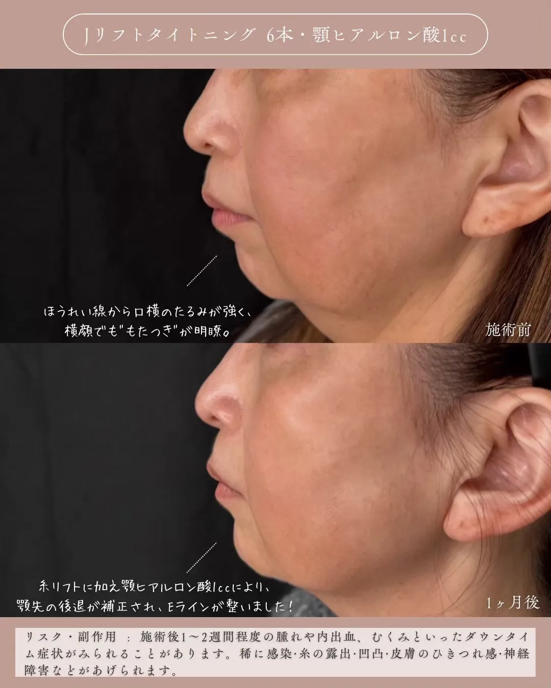 糸リフト＋ヒアルロン酸1_左横説明あり Before/After