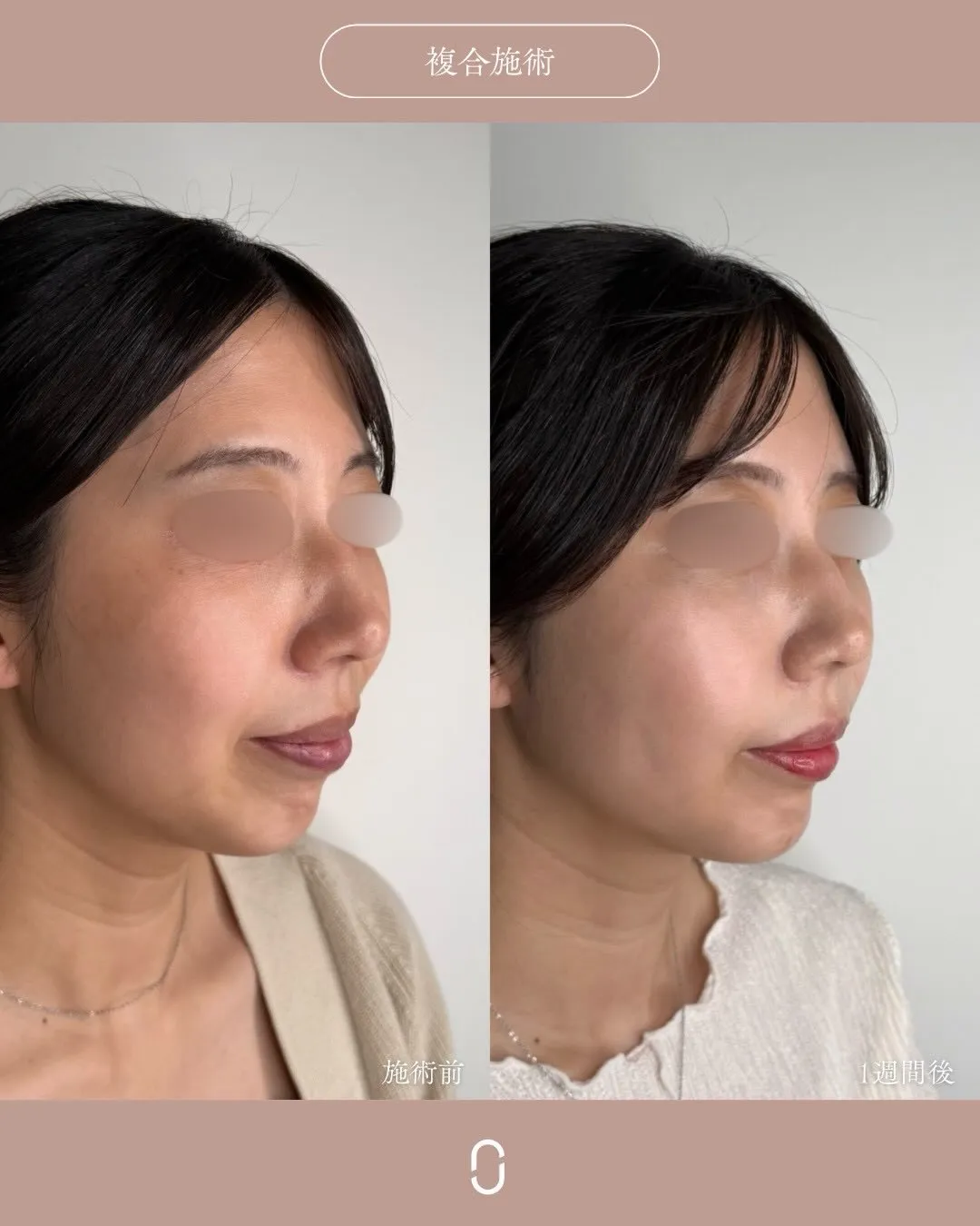 糸リフト＋ヒアルロン酸2_右斜め Before/After