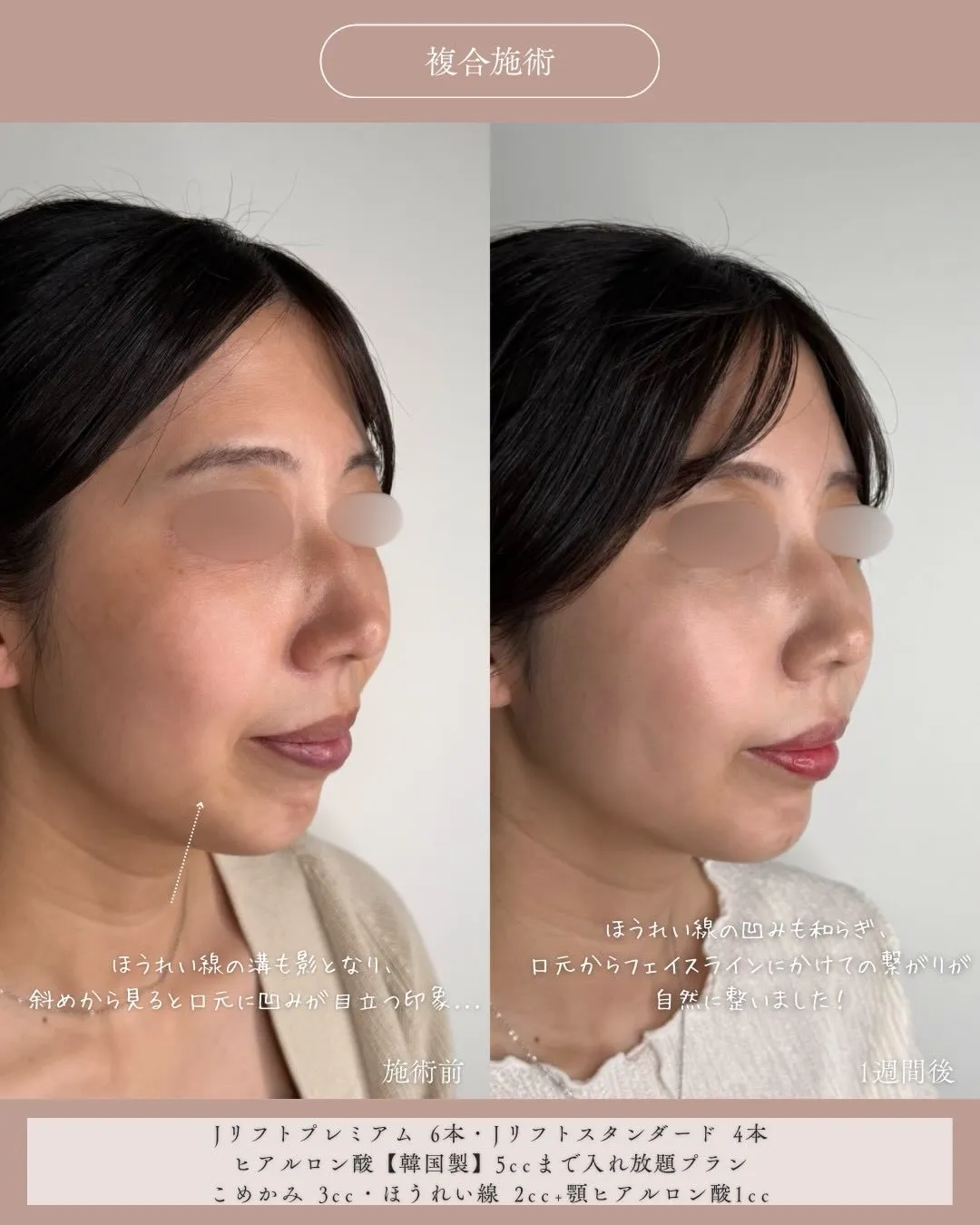 糸リフト＋ヒアルロン酸2_右斜め説明あり Before/After