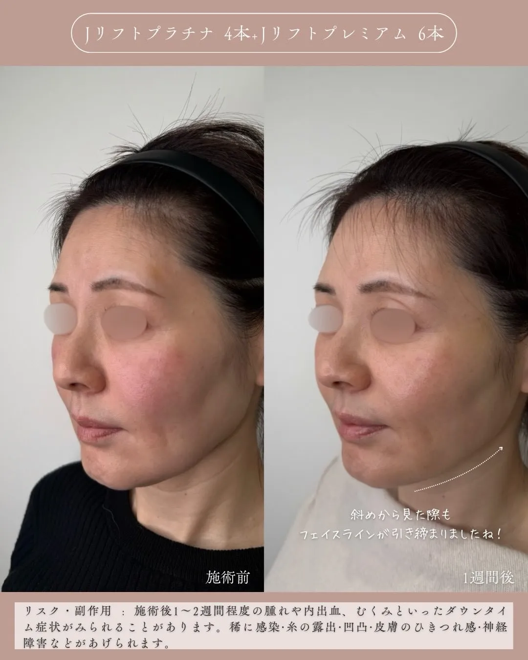 糸リフト＋ヒアルロン酸3_左斜め説明あり Before/After
