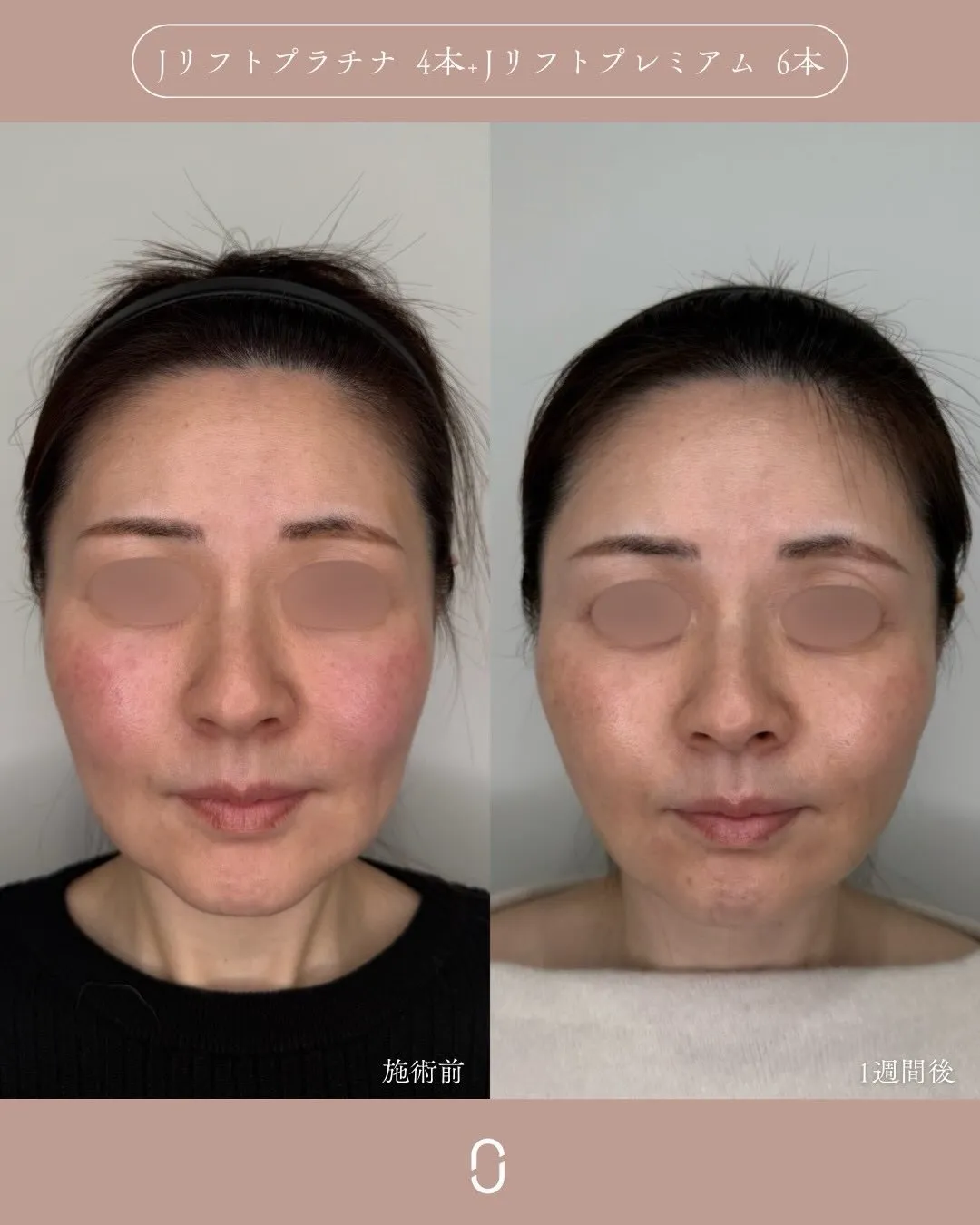 糸リフト＋ヒアルロン酸3_正面 Before/After