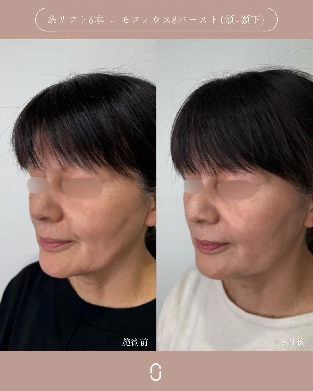 糸リフト＋モフィウス8バースト1_左斜め Before/After