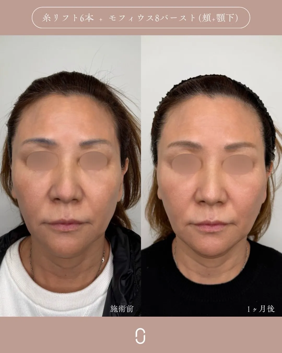 糸リフト＋モフィウス8バースト2_正面 Before/After