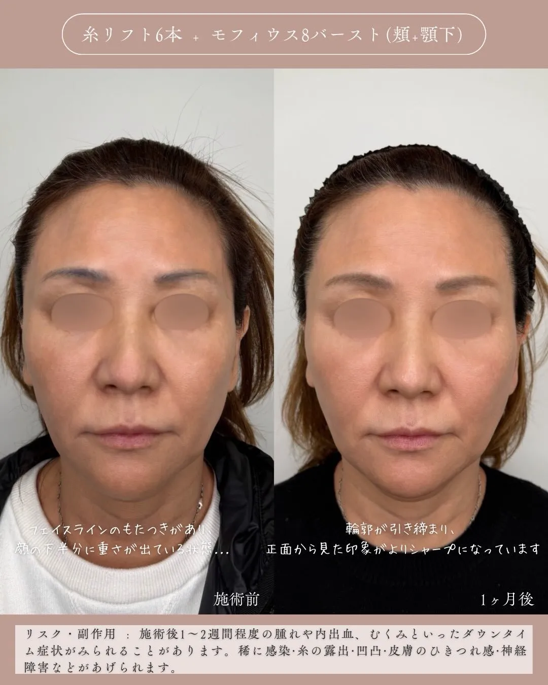 糸リフト＋モフィウス8バースト2_正面説明あり Before/After