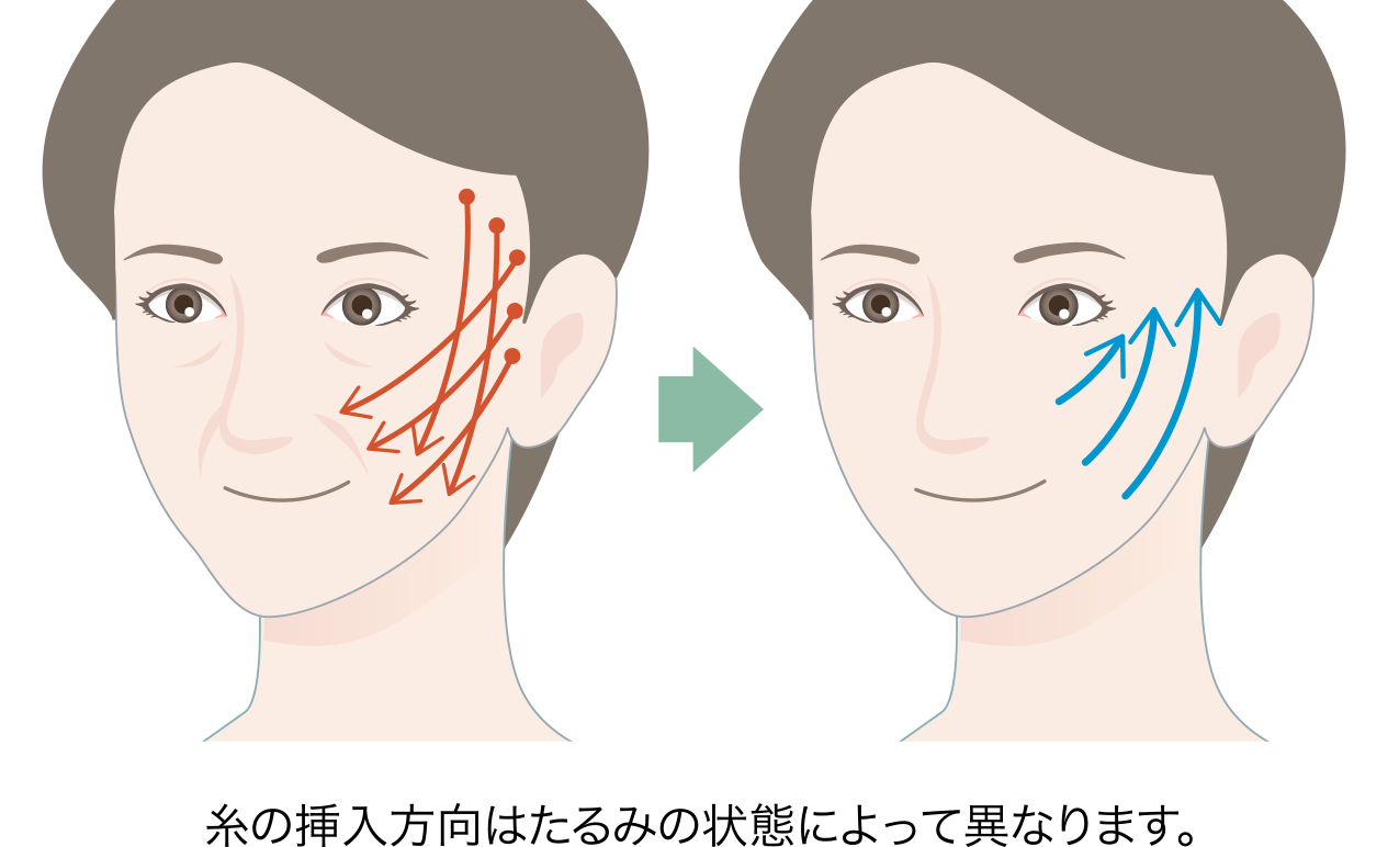 テスリフト〈コグ（トゲ）あり〉施術イメージ