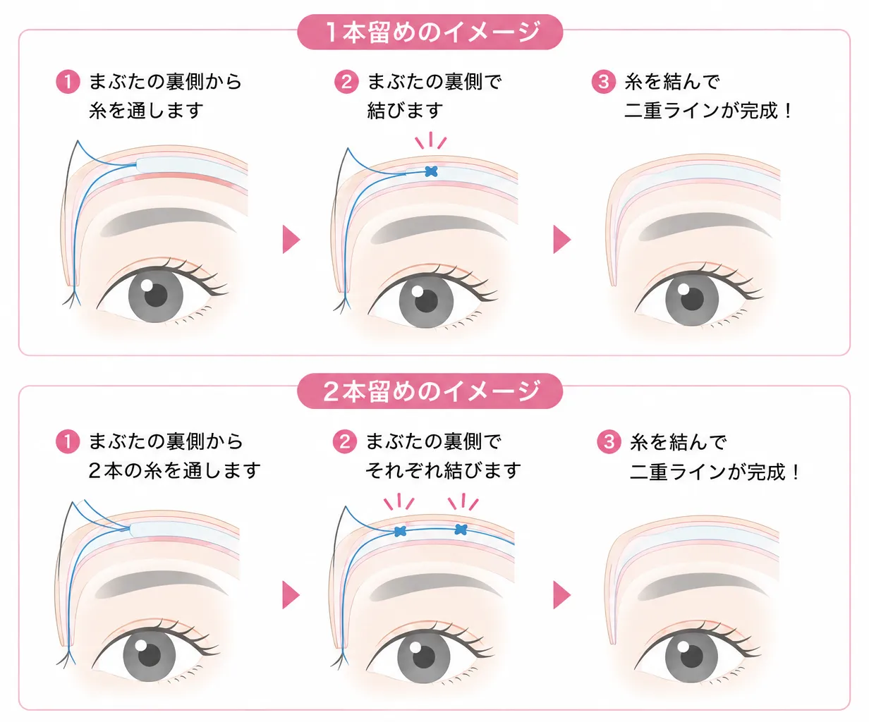 裏留め法(1本・2本)
