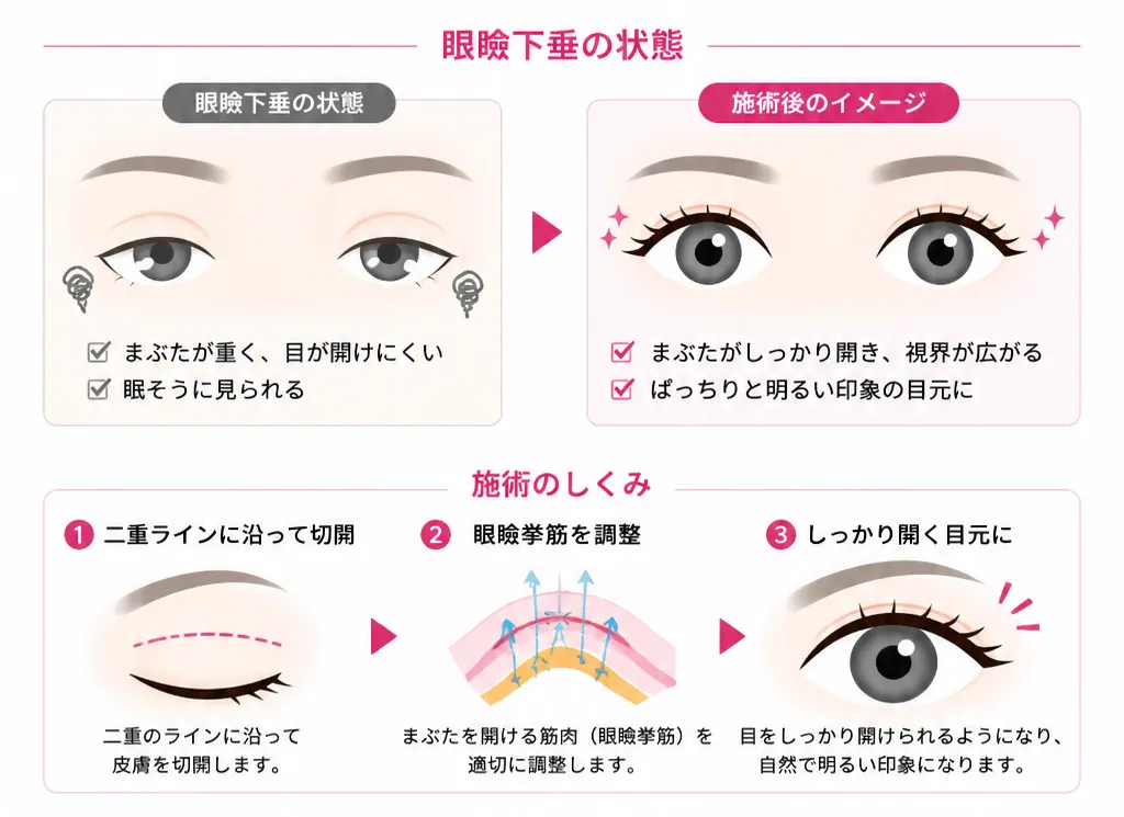 眼瞼下垂術