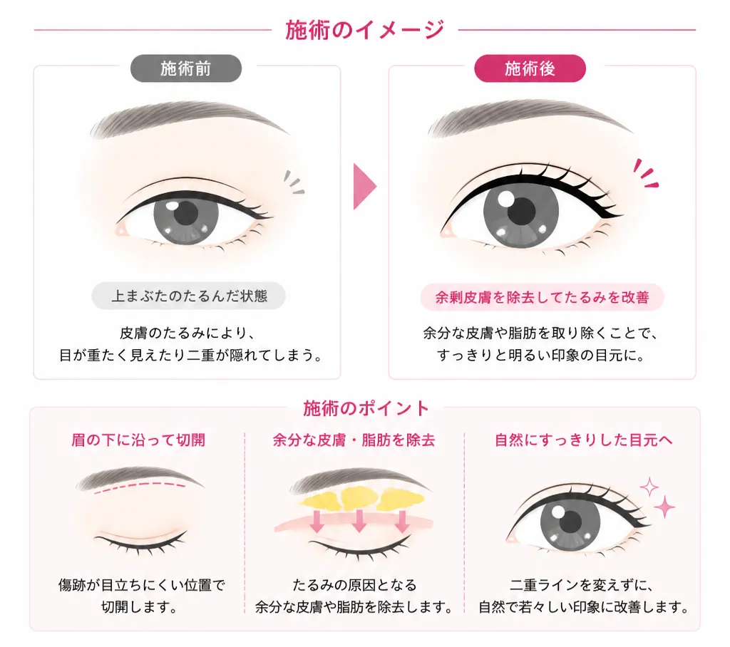 眉下切開
