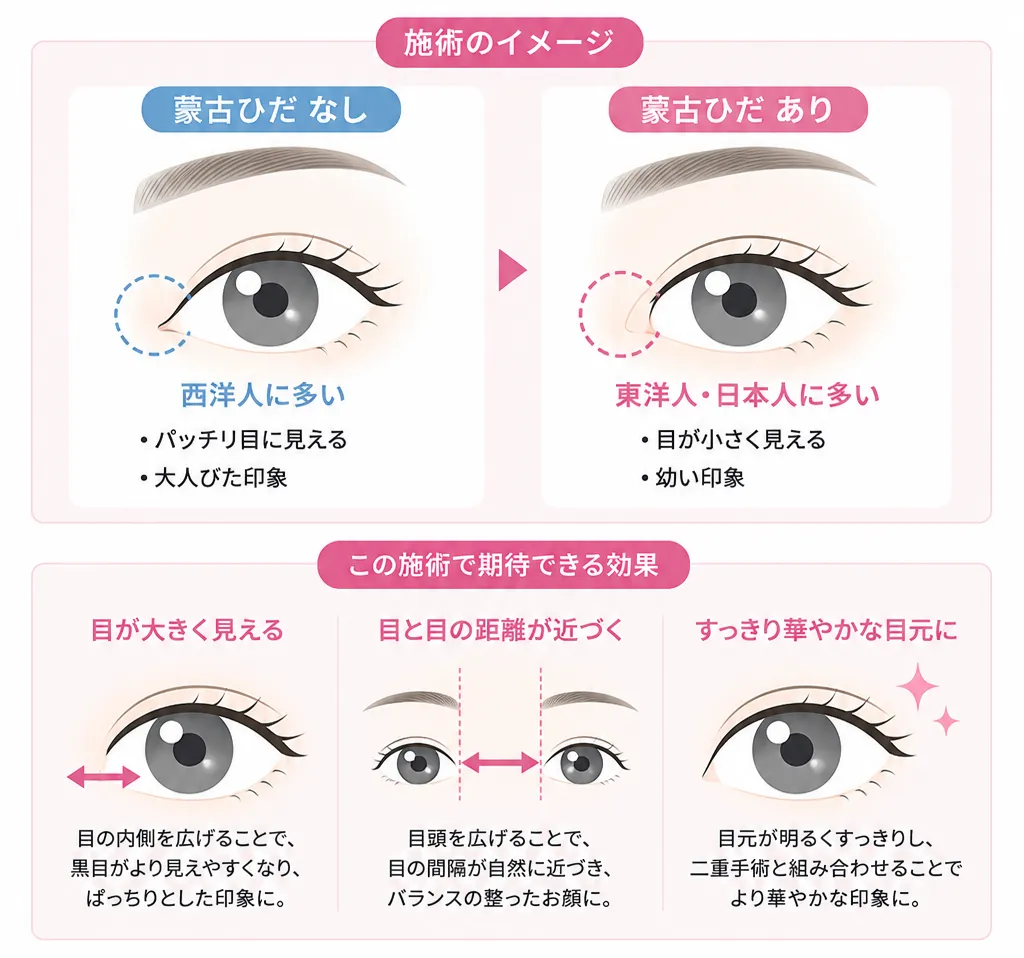 目頭切開