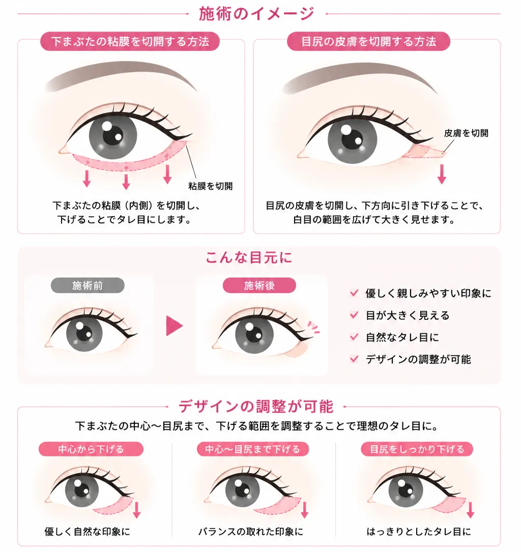 タレ目整形（グラマラス）