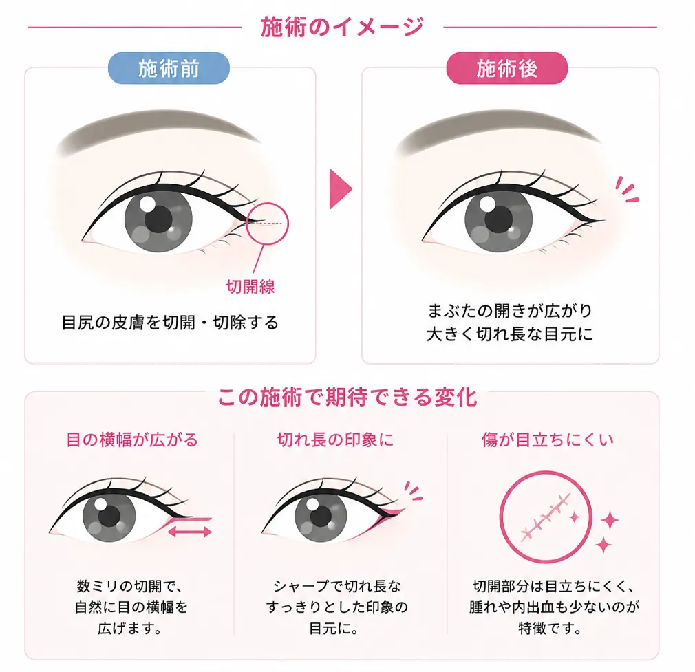 目尻切開