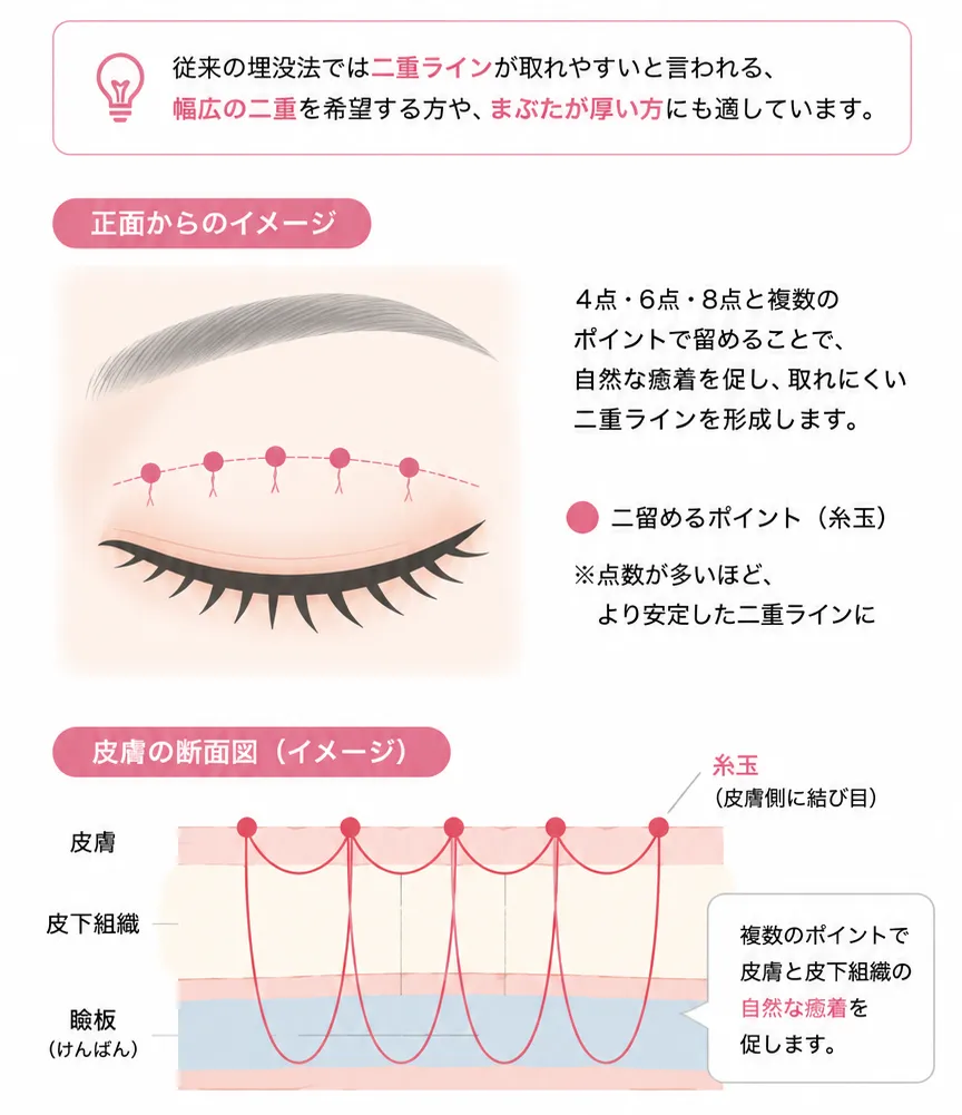 ハムラ法