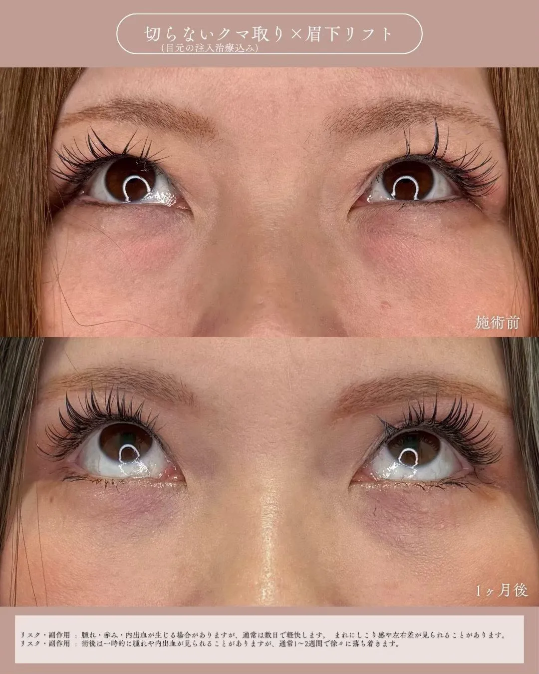 クマ取りセット＋眉下切開1_上向き Before/After