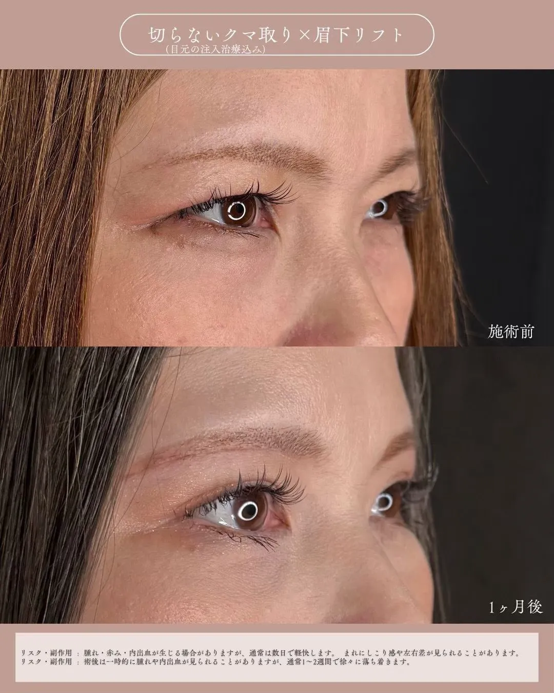 クマ取りセット＋眉下切開1_右横 Before/After
