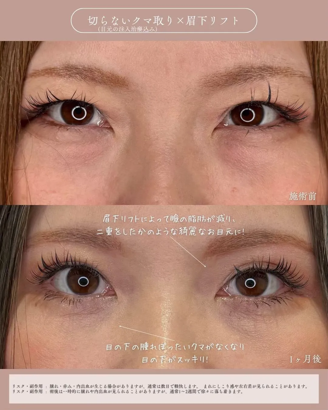 クマ取りセット＋眉下切開1_正面説明あり Before/After