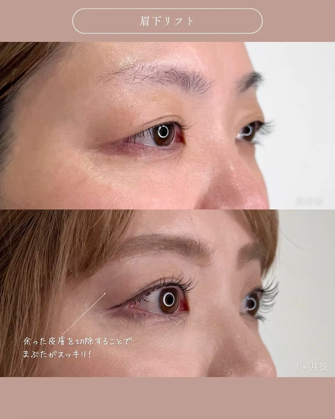 眉下リフト1_右横 Before/After