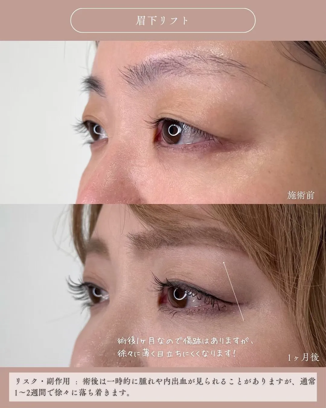 眉下リフト1_左横 Before/After