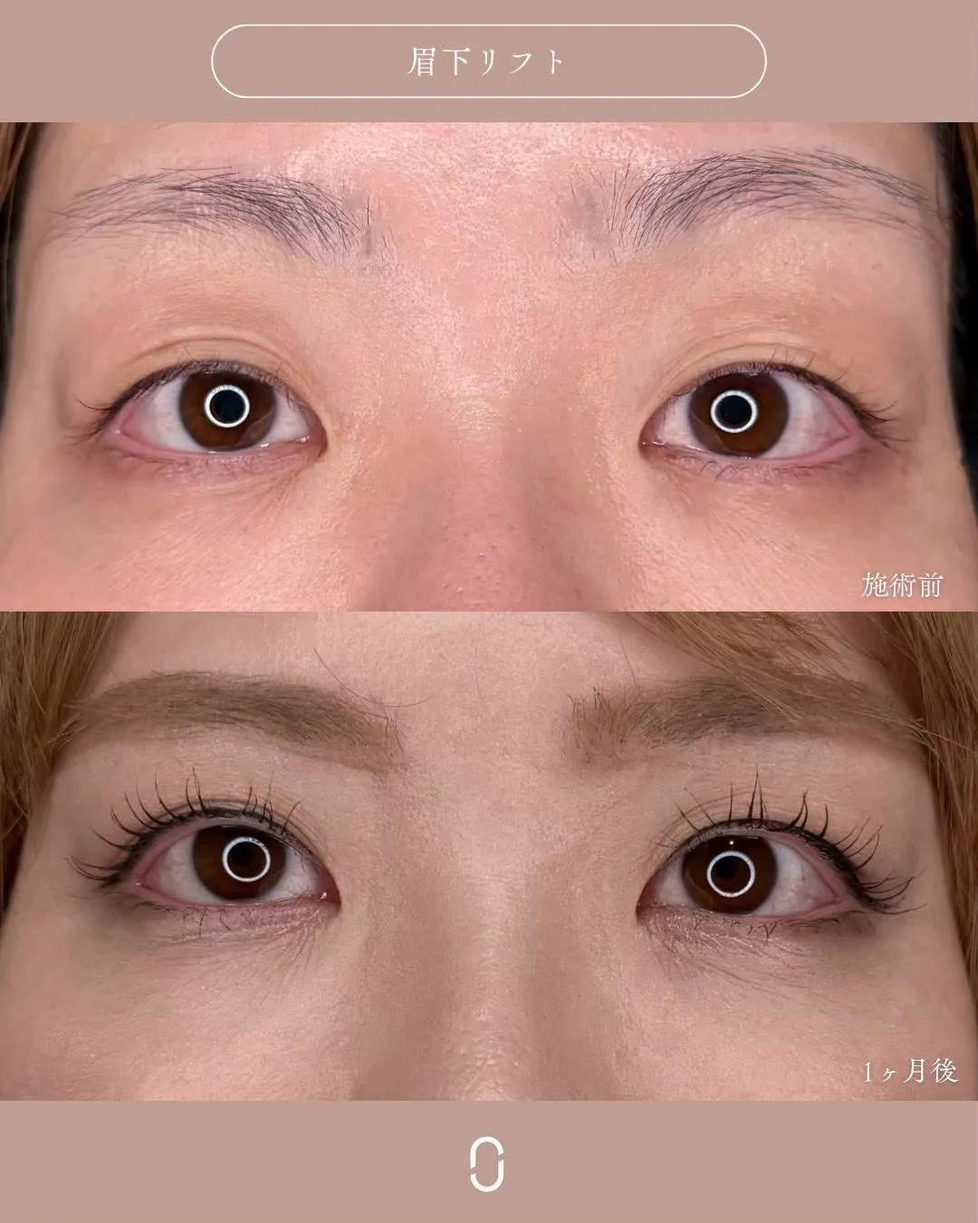 眉下リフト1_正面 Before/After
