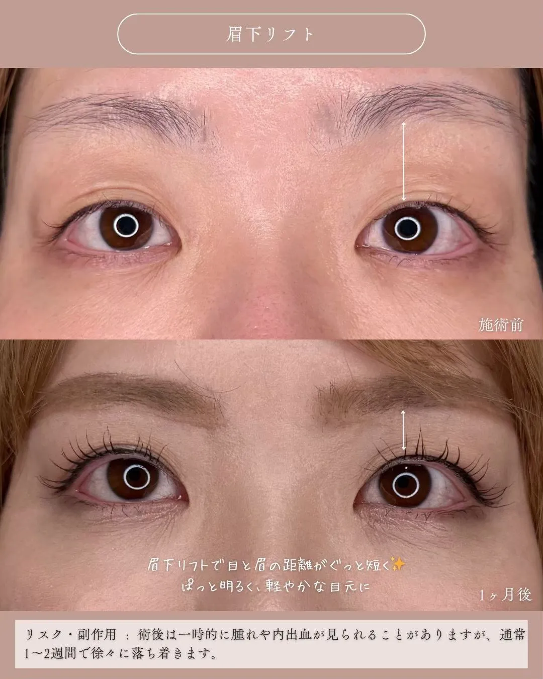 眉下リフト1_正面説明あり Before/After